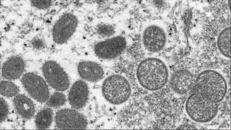Monkeypox: 97 cases confirmed in Ireland Monkeypox: 97 cases confirmed in Ireland