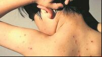 126% increase in hospitalisations from chickenpox